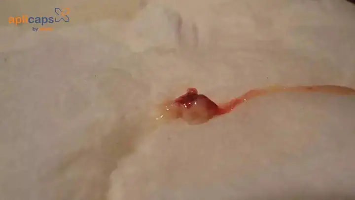 Đốm Màu Trắng Của Túi Thai