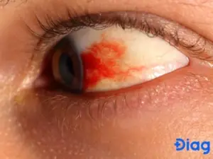 Các Biến Chứng Ở Mắt