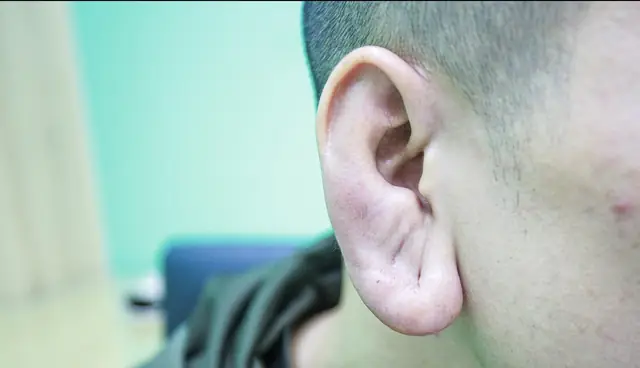 Hiểm Họa Từ Trào Lưu Nam Giới Tạo Tai Phật Bằng Tiêm Filler - Ảnh 2.