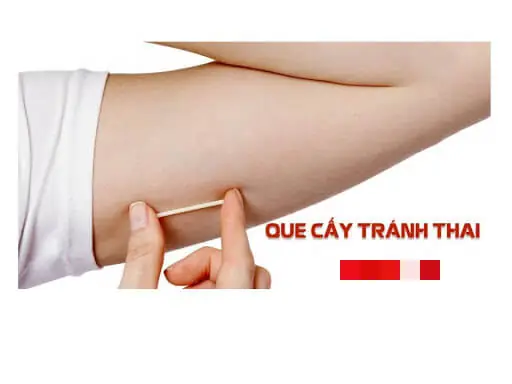 Tránh Thai Bằng Que Cấy Tránh Thai