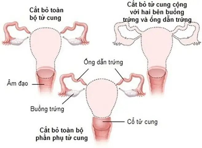 Cắt Tử Cung Hoàn Toàn Khiến Cơ Thể Bạn Thay Đổi Thế Nào? | Vinmec