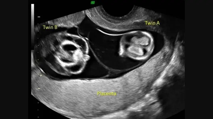 Song Thai 2 Túi Ối Là Cùng Trứng Hay Khác Trứng? [chuyên Gia ...