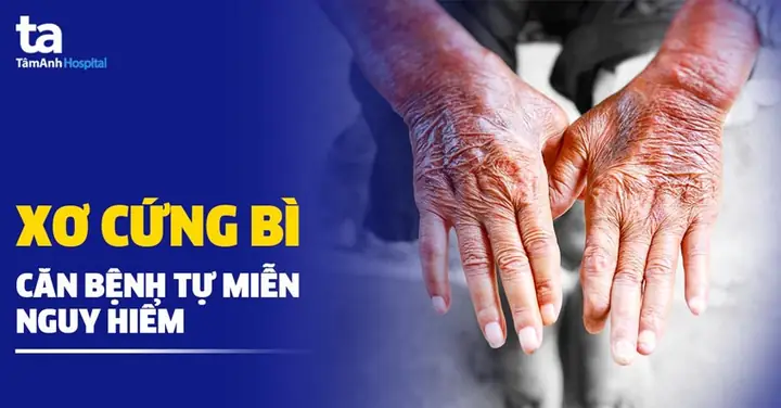 Xơ Cứng Bì: Nguyên Nhân, Triệu Chứng, Chẩn Đoán Và Điều Trị