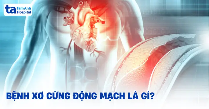 Bệnh Xơ Cứng Động Mạch: Nguyên Nhân, Triệu Chứng, Chẩn Đoán ...