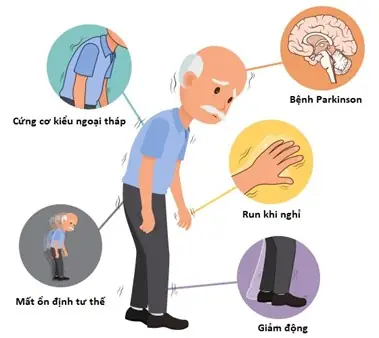 Triệu Chứng Vận Động Ở Bệnh Nhân Parkinson