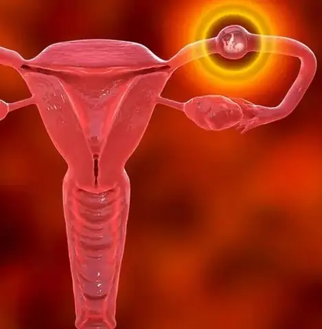 Thai Ngoài Tử Cung: Những Điều Cần Biết - Bệnh Viện Từ Dũ