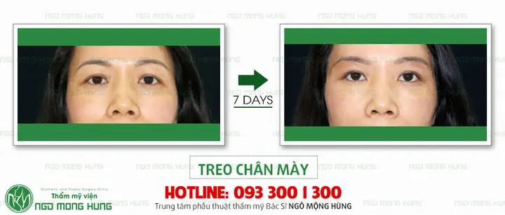 Chia Sẻ Kinh Nghiệm Nâng Cung Chân Mày Webtretho