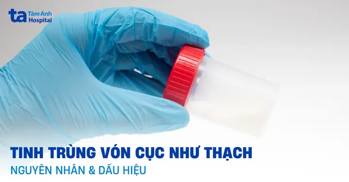 Nguyên Nhân Tinh Trùng Vón Cục Như Thạch: Khi Nào Cần Gặp Bác Sĩ?