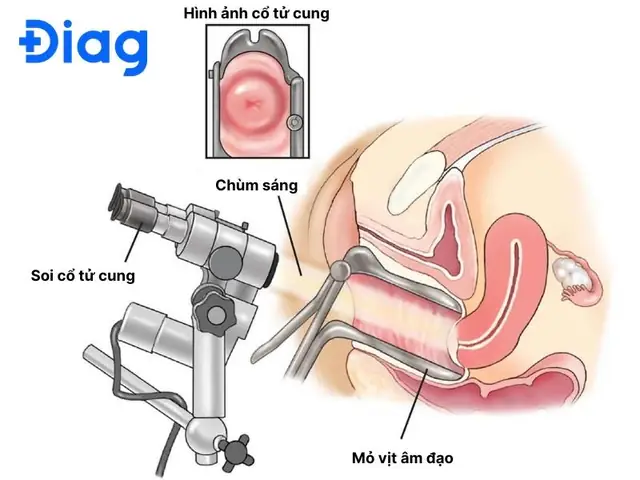 Sinh Thiết Cổ Tử Cung Là Gì? Sau Bao Lâu Có Kết Quả?