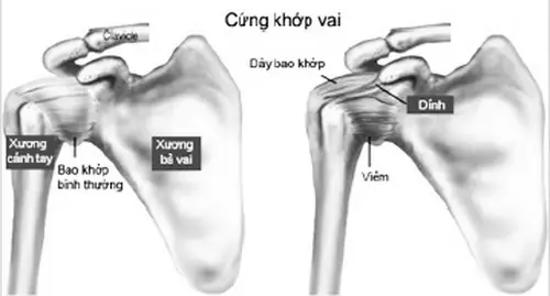 Đau Đông Cứng Khop Vai: Nguyên Nhân, Triệu Chứng Và Cách Khắc Phục Hiệu Quả