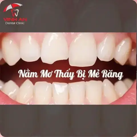 Giải Mã Giấc Mơ Bị Mẻ Răng: Điềm Báo Gì Và Ý Nghĩa Thực Tế