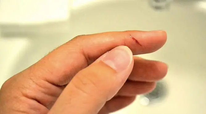 Giải Mã Giấc Mơ Thấy Đứt Tay Chảy Máu: Điềm Báo Tốt Hay Xấu?