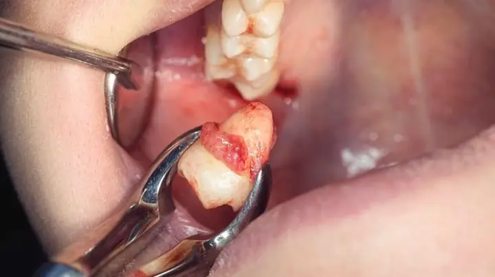 Giải Mã Giấc Mơ Rụng Răng Hàm Dưới: Thông Điệp Gì Từ Tiềm Thức?