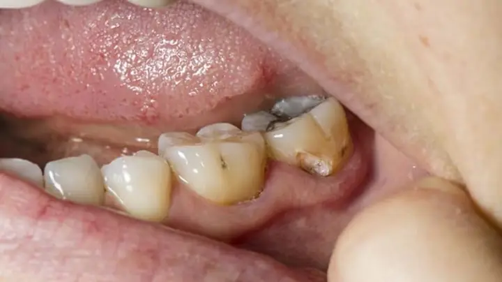 Giải Mã Giấc Mơ Rụng Răng Hàm Dưới: Thông Điệp Gì Từ Tiềm Thức?