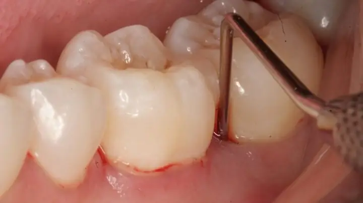 Giải Mã Giấc Mơ Rụng Răng Hàm: Thông Điệp Từ Tiềm Thức Về Sức Khỏe Và Tâm Lý