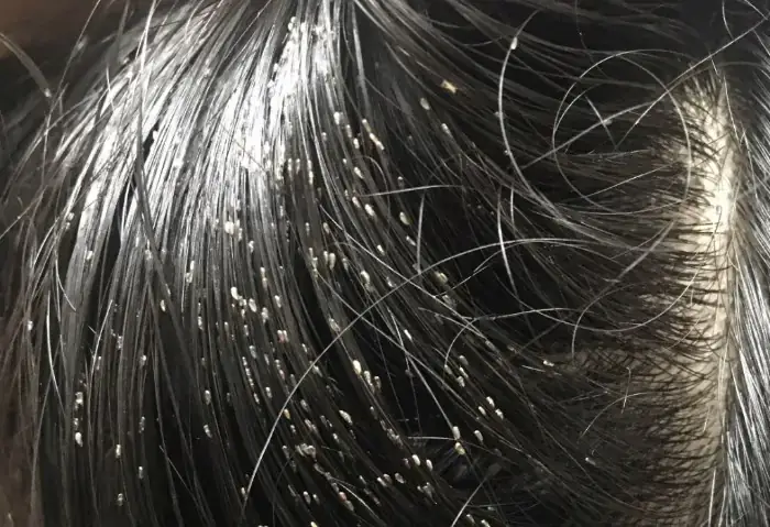 Giải Mã Giấc Mơ Thấy Chấy Rận: Điềm Báo Gì Và Nên Đánh Con Số May Mắn Nào?