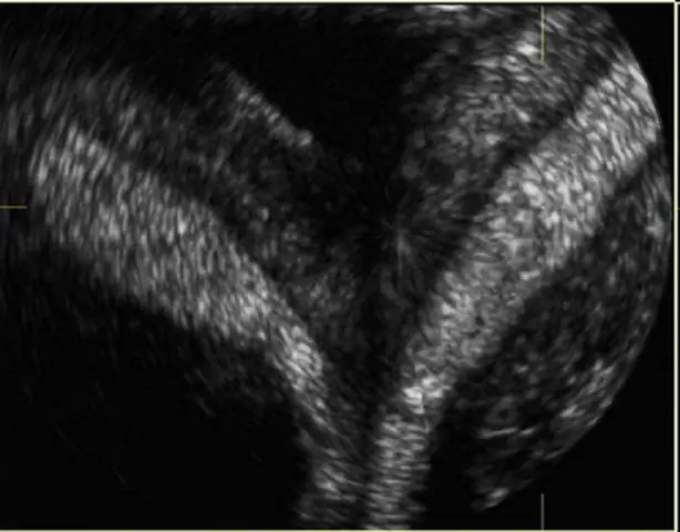 Tử Cung Hai Sừng Là Gì? Tử Cung Hai Sừng Ảnh Hưởng Như Nào Tới ...