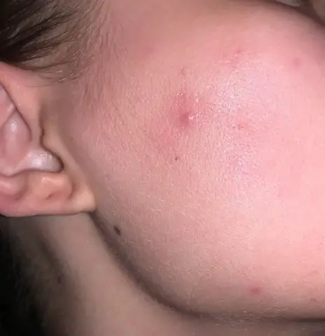 Mụn Cục Cứng Dưới Da: Đặc Điểm, Nguyên Nhân Và Cách Điều Trị