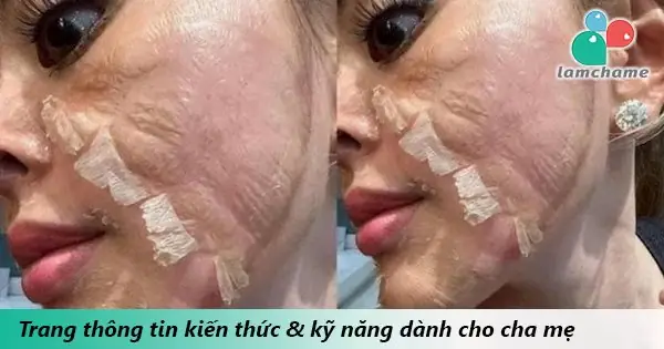 ''toang'' Cả Mặt Vì Tự Lột Da Làm Đẹp, Chi 70 Triệu Để Sửa Cũng Khó ...