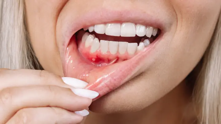 10 Nguyên Nhân Gây Nổi Cục Cứng Ở Lợi Có Thể Bạn Chưa Biết