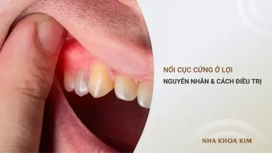 Nổi Cục Cứng Ở Lợi: Tìm Hiểu Nguyên Nhân Và Giải Pháp Điều Trị