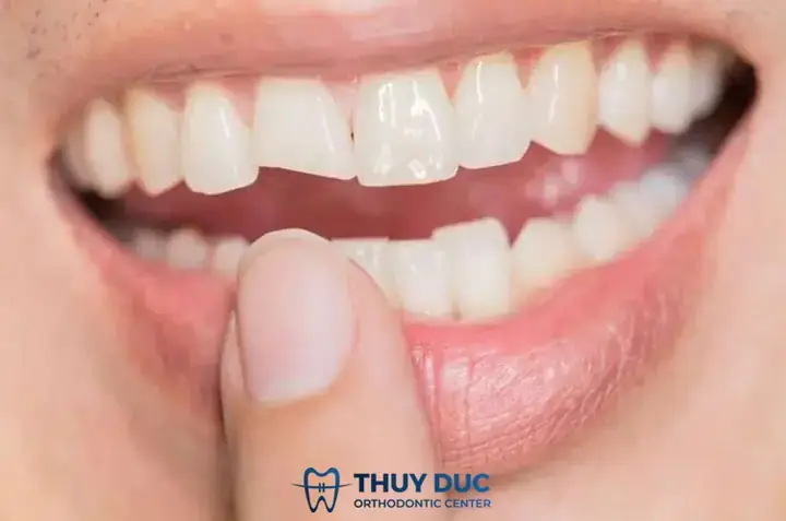 Giải Mã Giấc Mơ Bị Gãy Răng: Điềm Báo Tâm Linh, Tâm Lý Và Lời Khuyên Thực Tế