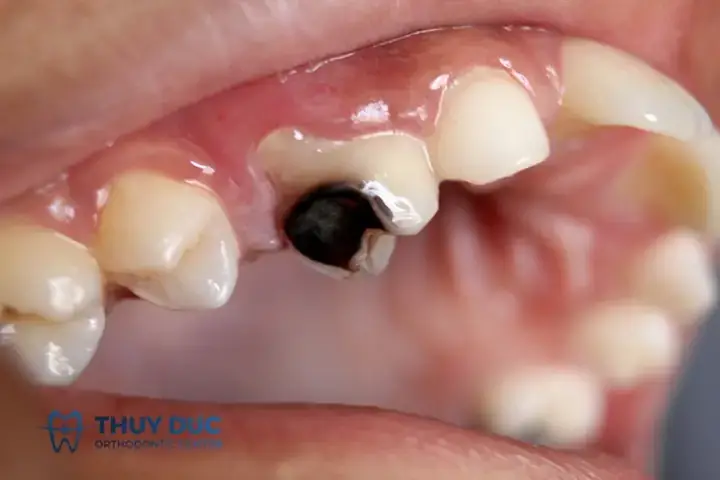 Giải Mã Giấc Mơ Bị Gãy Răng: Điềm Báo Tâm Linh, Tâm Lý Và Lời Khuyên Thực Tế