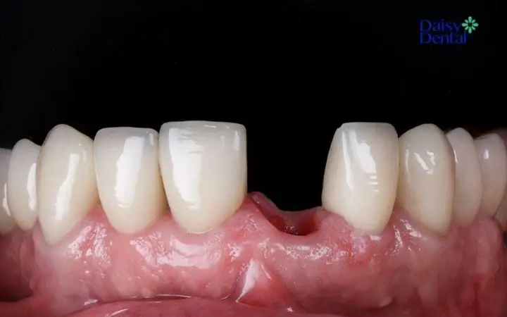 Giải Mã Ý Nghĩa Giấc Mơ Rụng Răng Không Chảy Máu: Điềm Lành Hay Dữ?