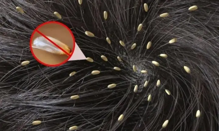 Giải Mã Giấc Mơ Thấy Chấy Trên Đầu Và Các Con Số May Mắn Đi Kèm