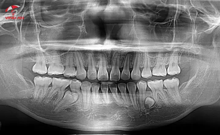 Giải Mã Giấc Mơ Thấy Trẻ Con Mọc Răng: Chi Tiết Điềm Báo Tốt Xấu Và Con Số May Mắn