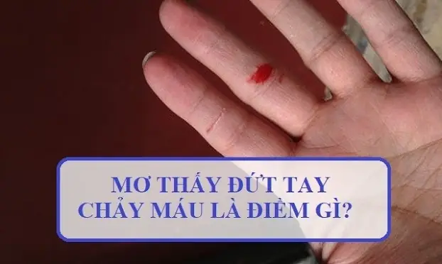 Giải Mã Ý Nghĩa Giấc Mơ Đứt Tay Chảy Máu Và Những Con Số May Mắn Liên Quan
