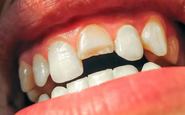 Nằm Mơ Thấy Mẻ Răng Không Chảy Máu: Giải Mã Ý Nghĩa Và Những Điềm Báo Đằng Sau