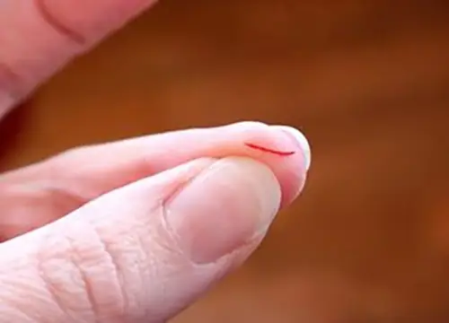 Giải Mã Chi Tiết Giấc Mơ: Nằm Mơ Thấy Người Khác Đứt Tay Chảy Máu