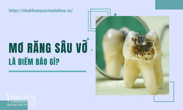 Giải Mã Giấc Mơ: Nằm Mơ Thấy Răng Sâu Bị Vỡ Là Điềm Gì Và Nên Làm Gì?