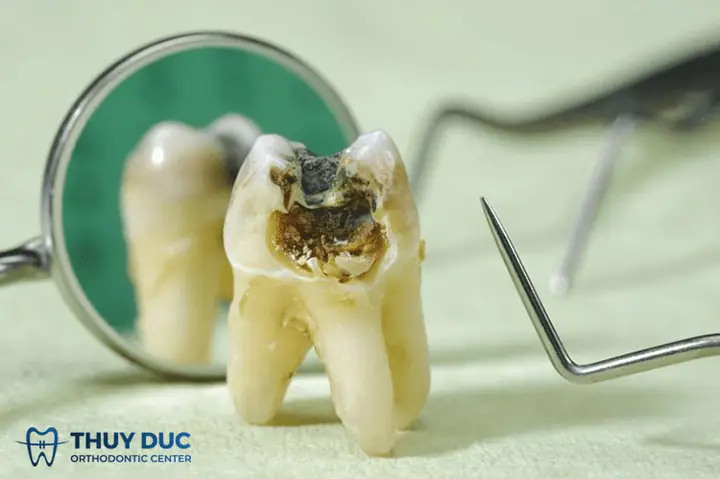 Giải Mã Giấc Mơ: Nằm Mơ Thấy Răng Sâu Bị Vỡ Là Điềm Gì Và Nên Làm Gì?