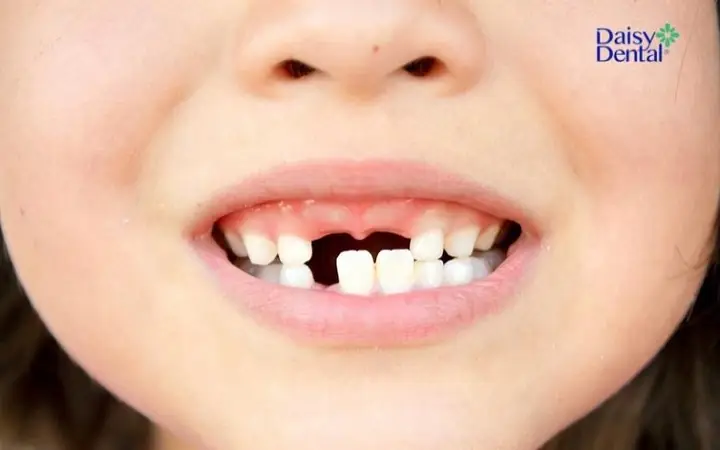 Nằm Mơ Thấy Rụng Răng Hàm Trên: Giải Mã Chi Tiết Ý Nghĩa Và Các Con Số May Mắn