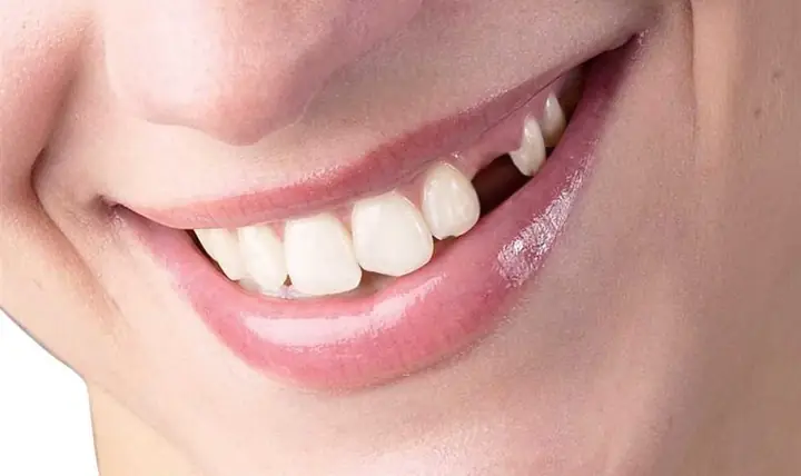 Giải Mã Giấc Mơ Thấy Rụng Răng Hàm Trên Không Chảy Máu: Điềm Báo Gì Và Nên Làm Gì?