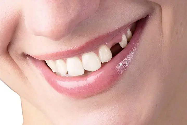 Giải Mã Giấc Mơ Thấy Rụng Răng Hàm Trên Không Chảy Máu: Điềm Báo Gì Và Nên Làm Gì?