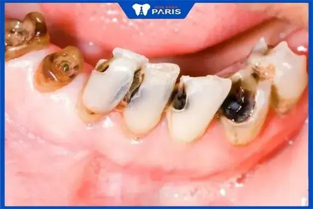 Giải Mã Ý Nghĩa Nằm Mơ Thấy Tự Nhổ Răng Mình: Điềm Báo Gì Và Cách Xử Lý