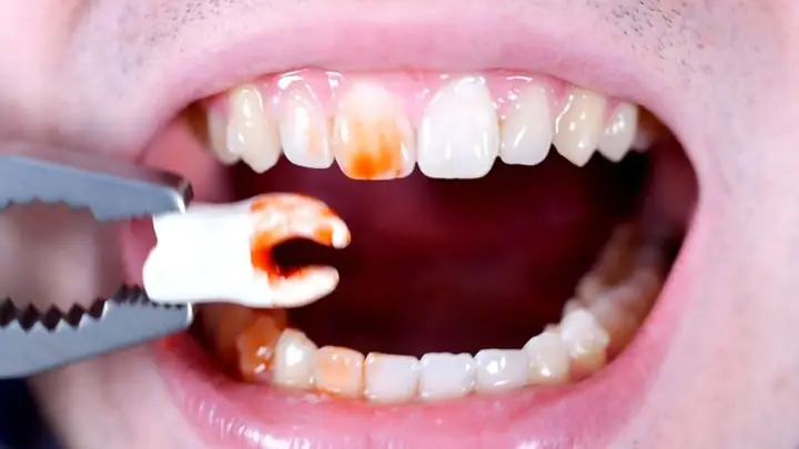 Giải Mã Ý Nghĩa Giấc Mơ Thấy Tự Nhổ Răng Sâu: Điềm Lành Hay Dữ?