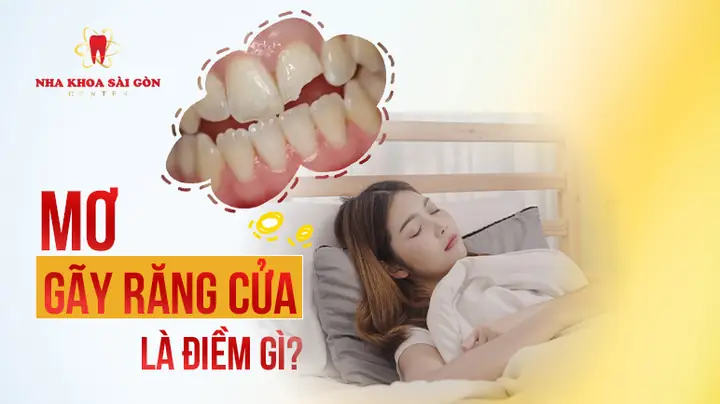 Giấc Mơ Thấy Gãy Răng Cửa Trên: Ý Nghĩa Chi Tiết Và Cách Xử Lý