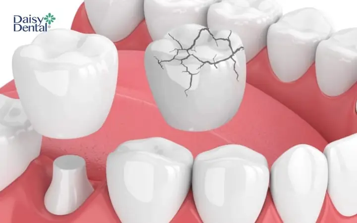 Giấc Mơ Về Răng Sứ: Giải Mã Thông Điệp Từ Tiềm Thức Và Góc Nhìn Thực Tế